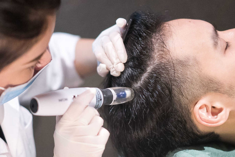 Scalp microneedling hair loss treatment at HDA Clinic Bryanston