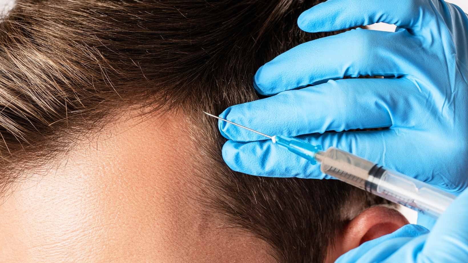 Peptide hair filler treatment at HDA Clinic Bryanston