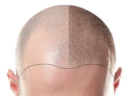 Scalp Microdot Pigmentation SMP at HDA Clinic Johannesburg
